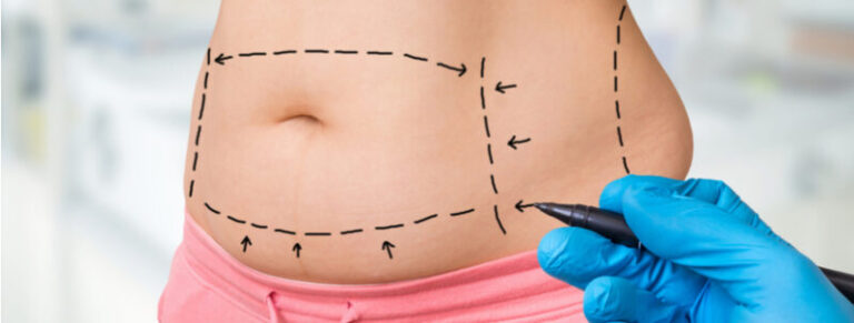 full tummy tuck belly button