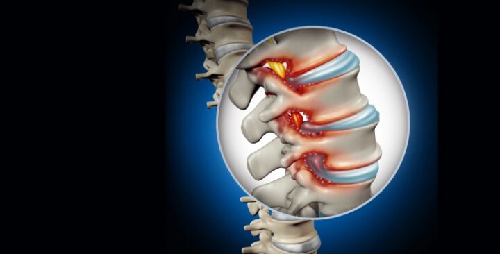 What Causes Low Back Pain and How Can You Treat It?